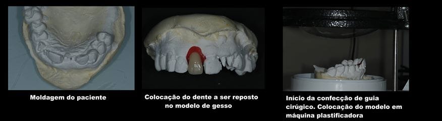 Planejamento de implante — moldagem, simulação do dente e confecção do guia