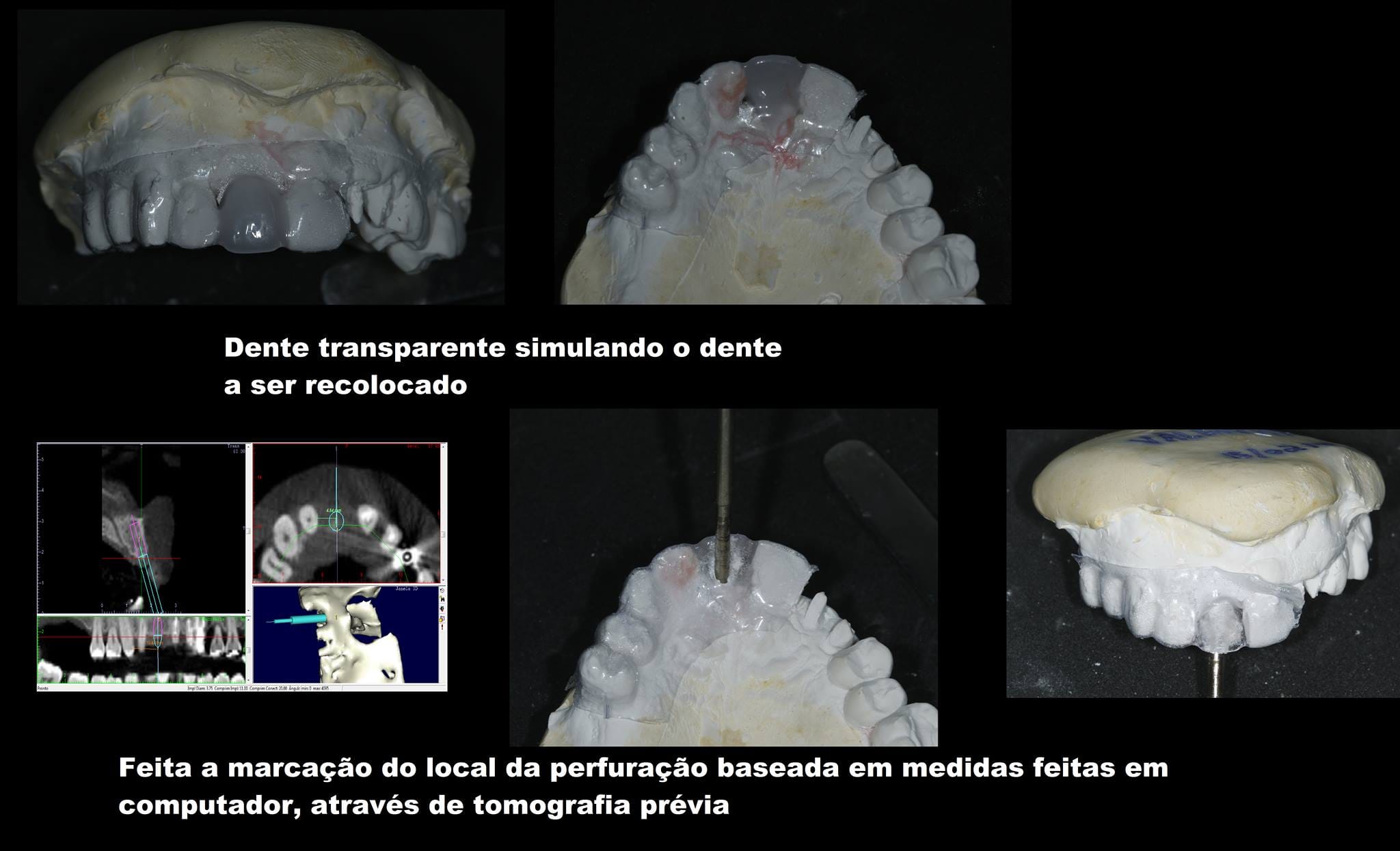 Guia cirúrgico com marcação baseada em tomografia — posição exata do implante