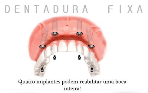 Sem título 2 - Dentadura Convencional