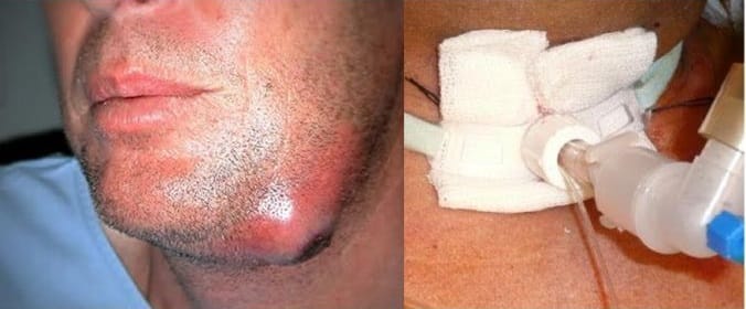 Angina de Ludwig — infecção dentária não tratada — perigo de abscesso dentário — urgência odontológica