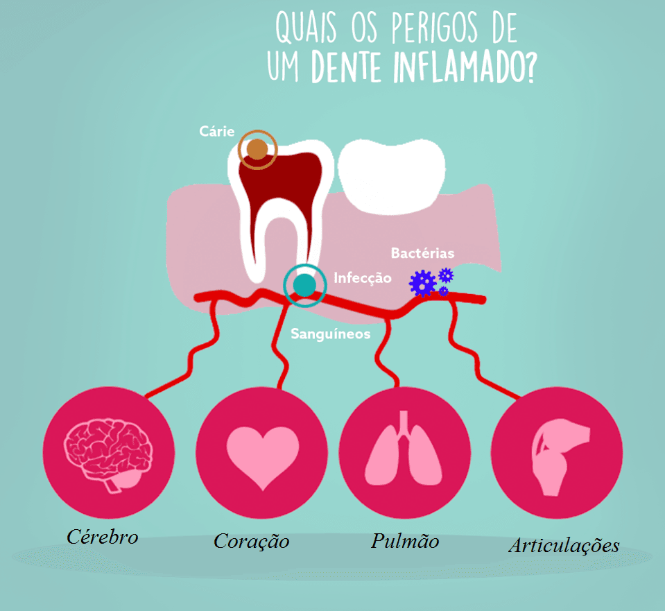 Perigos de dente infeccionado — bactérias atingem cérebro, coração, pulmão e articulações