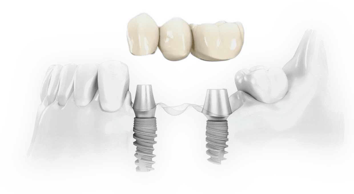 2 implantes dentários repõem 3 ou mais dentes — ponte sobre implantes
