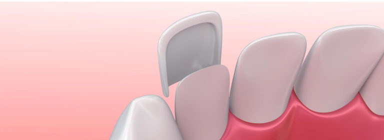 veneers 768x280 - Estética