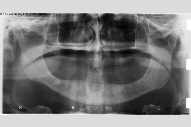 Desdentado Total1 - Dentadura Fixa