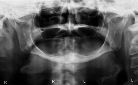 Desdentado Total2 - Dentadura Fixa