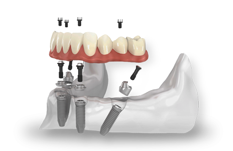 all on four 01 - Dentadura Fixa