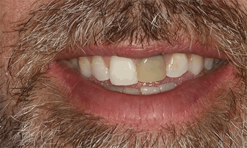 Exemplo clínico: um dente da frente escurecido