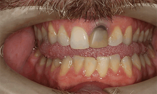 Dente escurecido por necrose pulpar