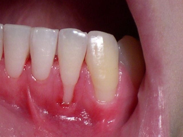 Recessão gengival real — raiz exposta nos dentes inferiores