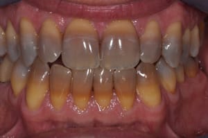 Manchas de tetraciclina nos dentes — indicação para facetas de porcelana