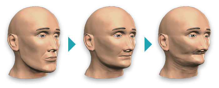 Progressão da perda óssea facial ao longo dos anos sem implantes