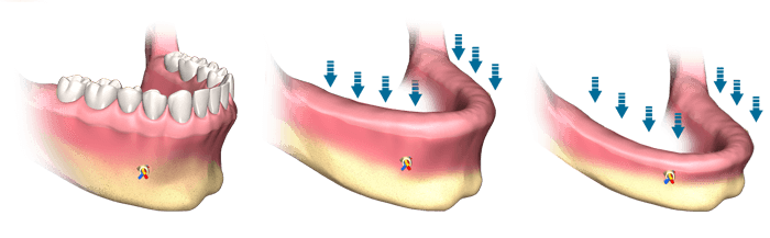 Perda óssea progressiva sob a dentadura — reabsorção do rebordo