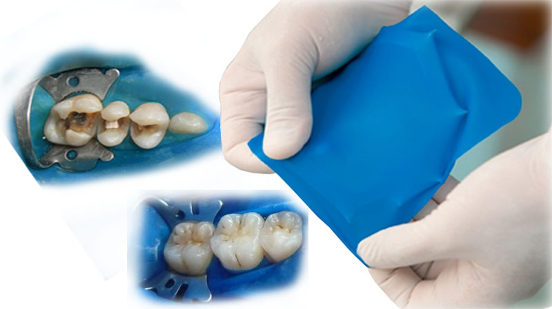 Isolamento absoluto com lençol de borracha — proteção durante o canal