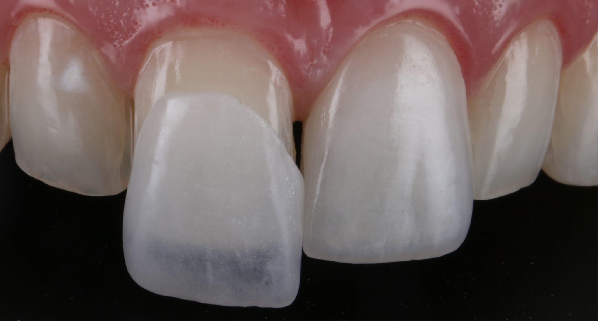 Lente de contato dental sendo posicionada no dente