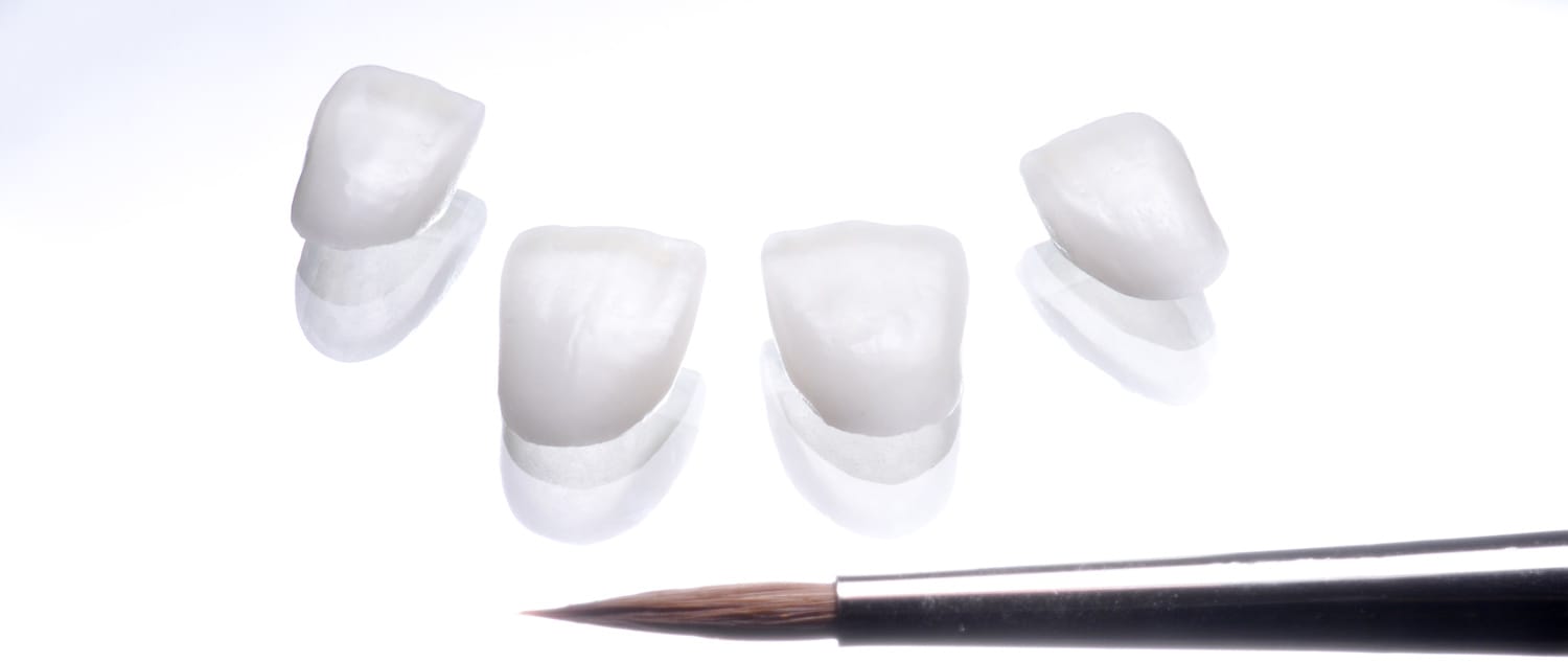 Lentes de contato dental de porcelana — peças prontas para cimentação