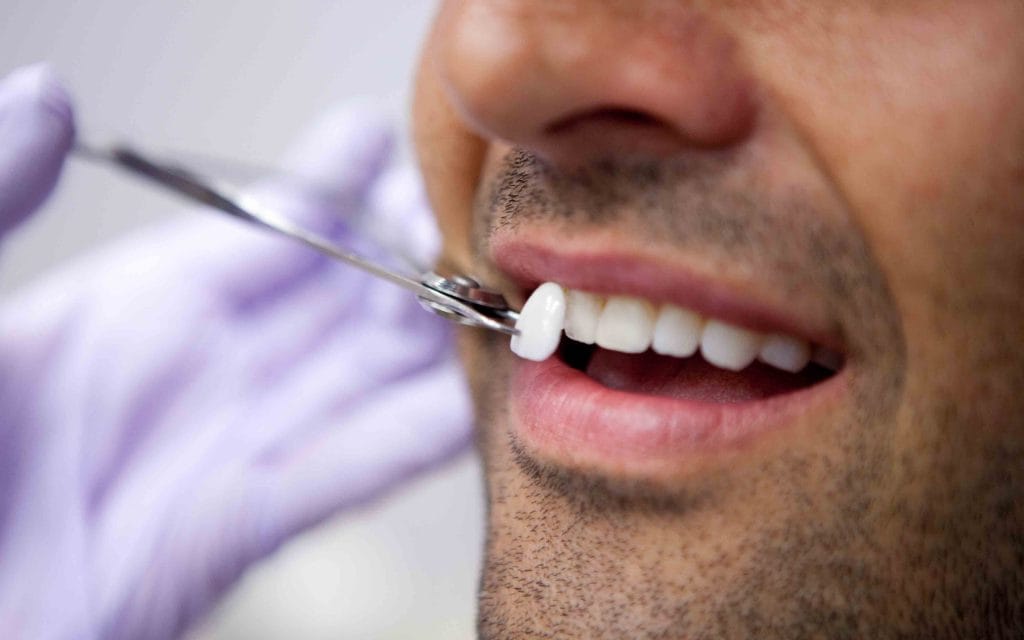 Faceta de porcelana sendo posicionada no dente do paciente