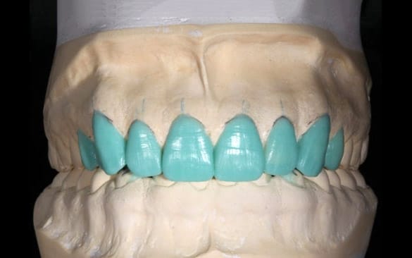 Desenho digital do sorriso — formato e proporção de cada dente planejados no computador