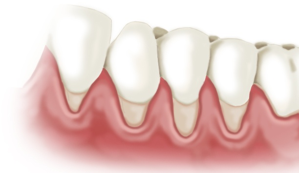 Ilustração de recessão gengival — gengiva retraída expondo as raízes dos dentes — gengiva descendo — recessão gengival Divinópolis MG
