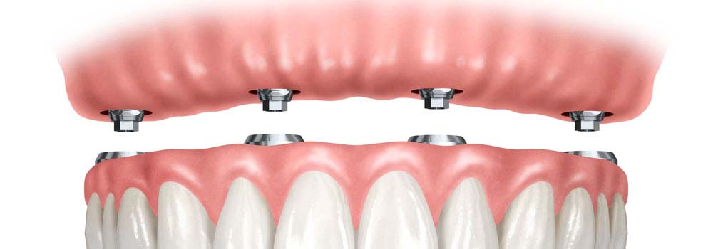 Denture implants 3 - Dentadura Fixa