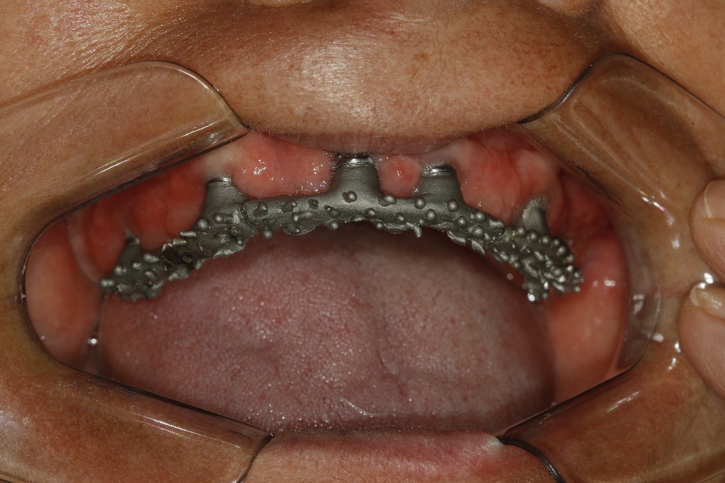 Caso clínico dentadura fixa — antes e depois