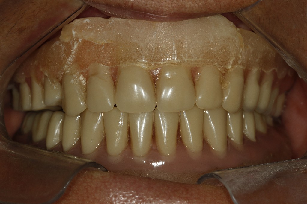 Dentadura fixa sobre implante dentário Divinópolis — caso 1