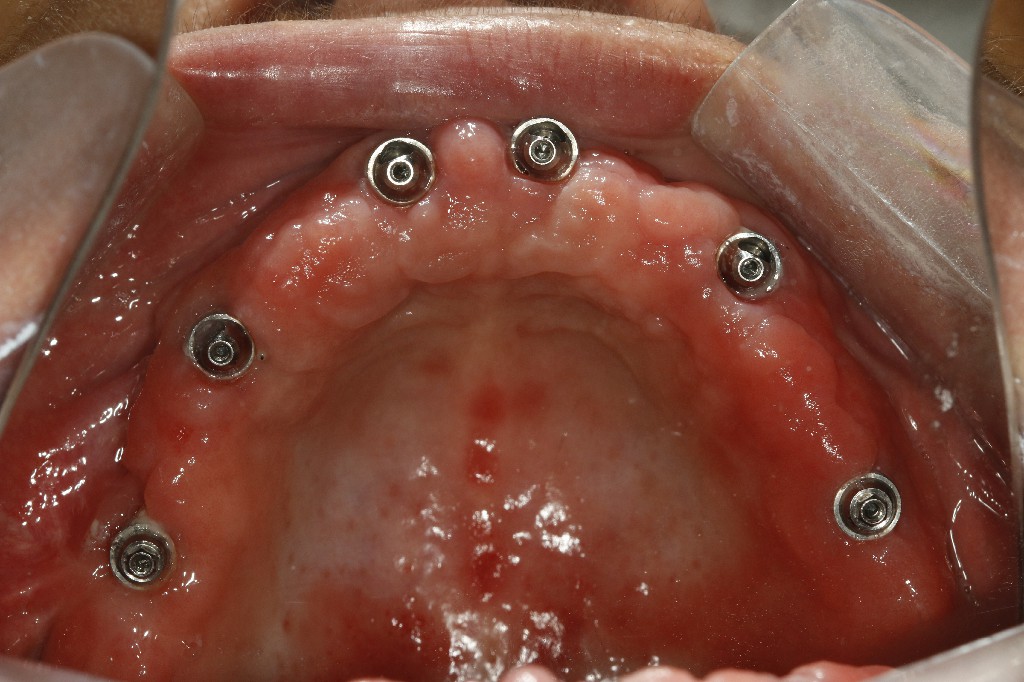 Resultado reabilitação oral completa — arcada fixa
