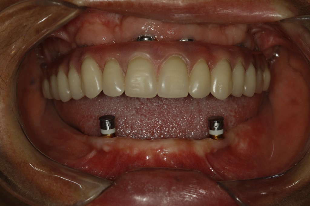 Reabilitação total com prótese fixa — sorriso completo