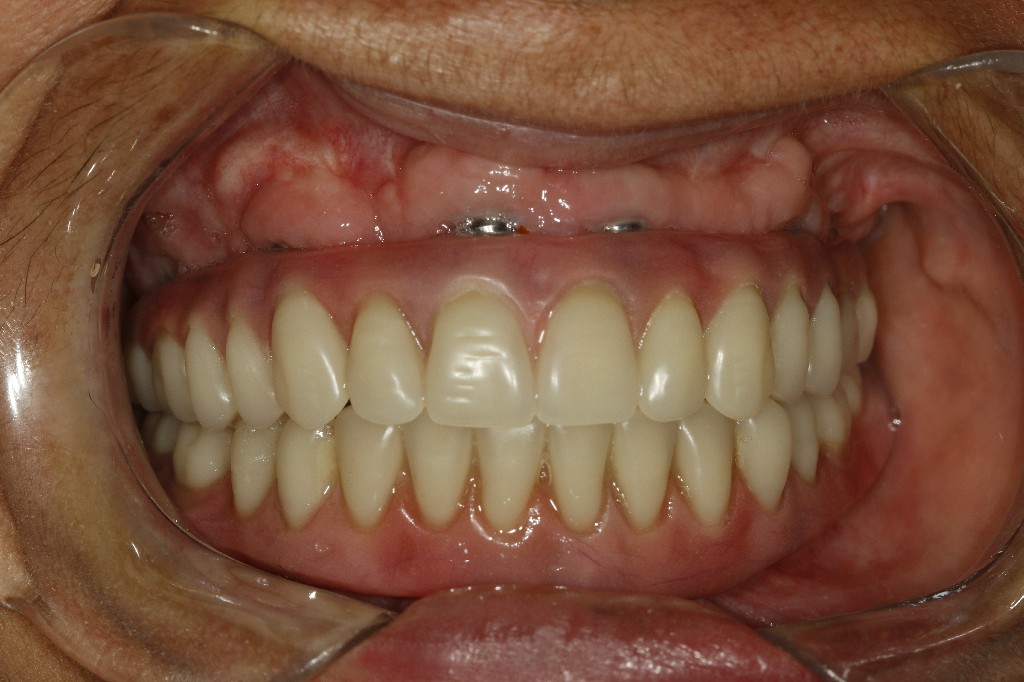 Caso finalizado — arcada reabilitada com dentes fixos