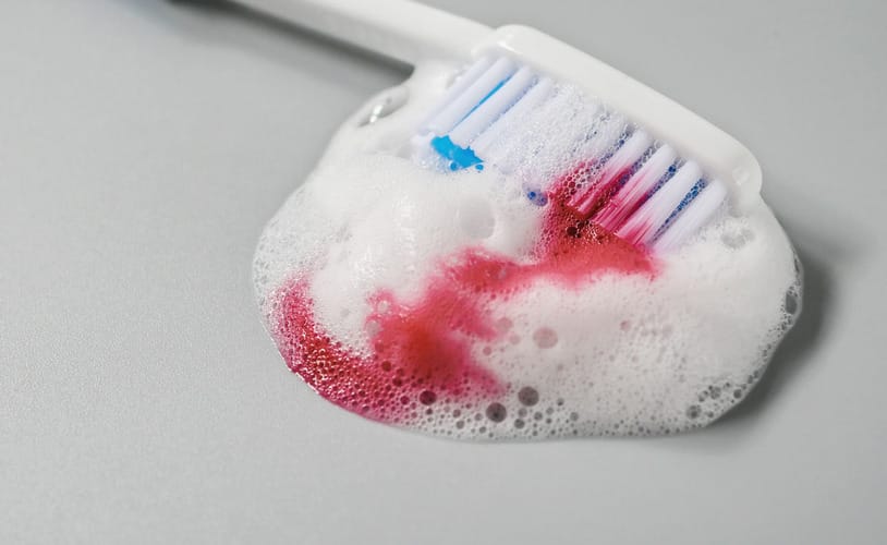 Reabilitação oral Divinópolis — tratamento de gengiva sangrando (gengivite)