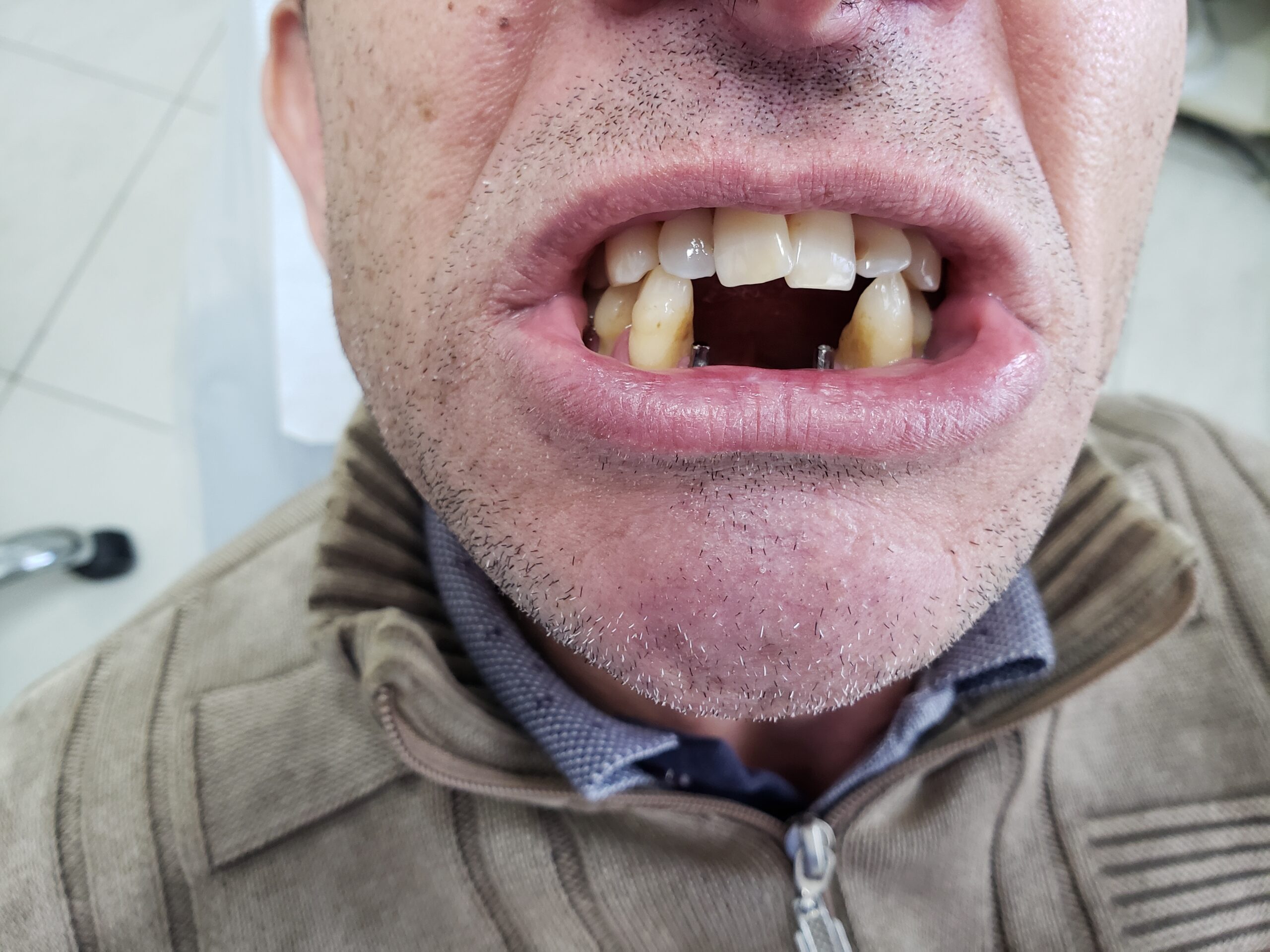 Resultado ponte fixa — reabilitação parcial com prótese