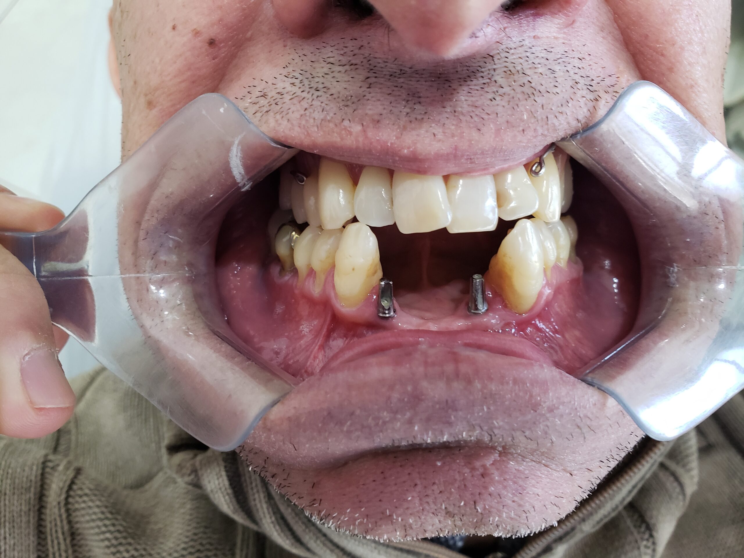 Ponte sobre implante dentário Divinópolis — caso clínico