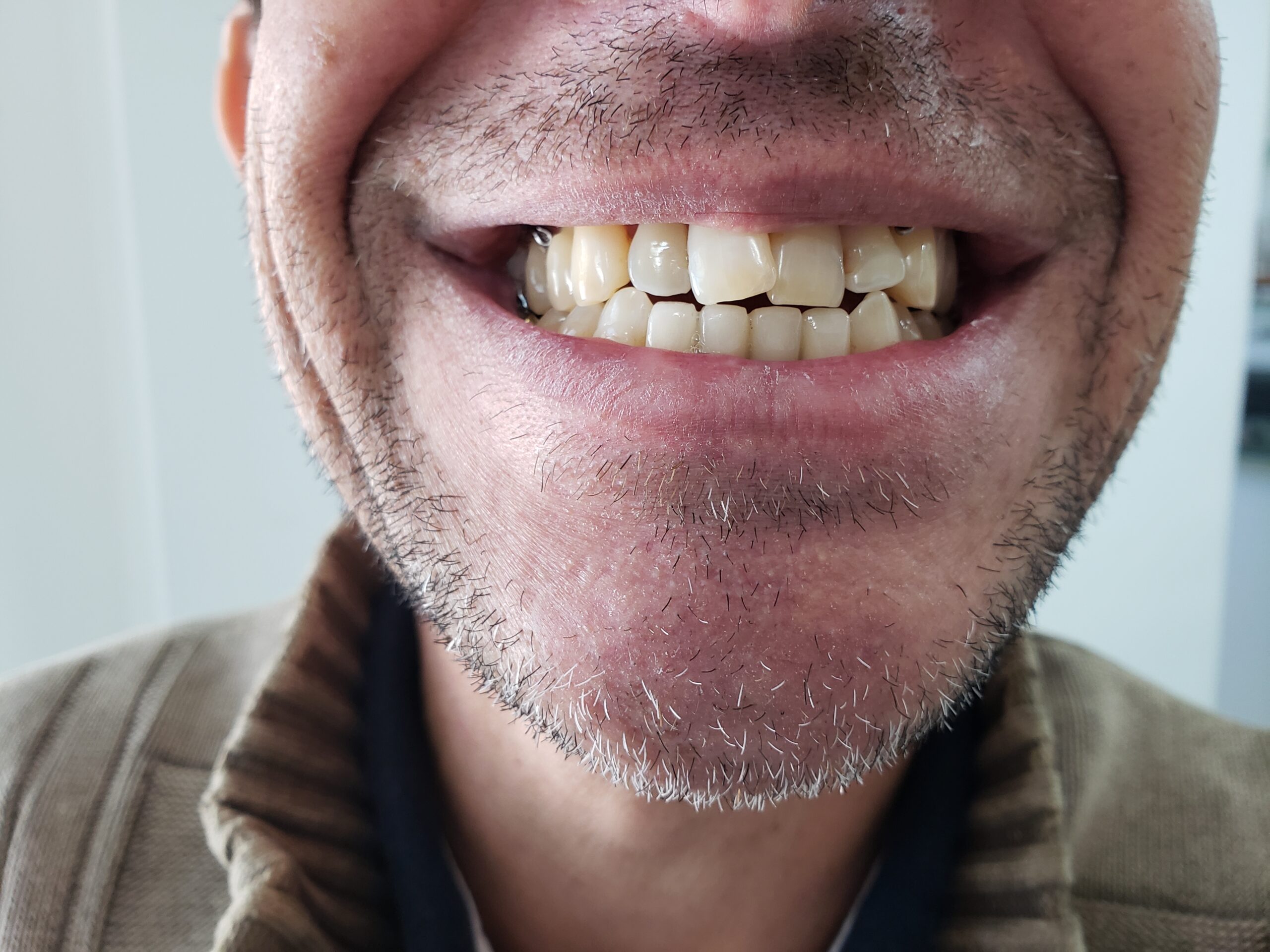 Resultado ponte sobre implantes