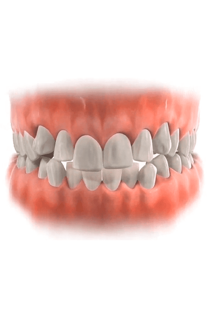 Reabilitação oral Divinópolis — dentes apinhados causando desequilíbrio da mordida