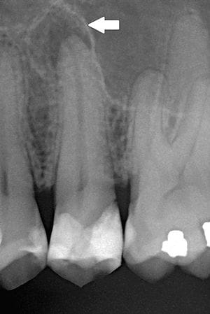 Radiografia mostrando lesão periapical — infecção na raiz do dente