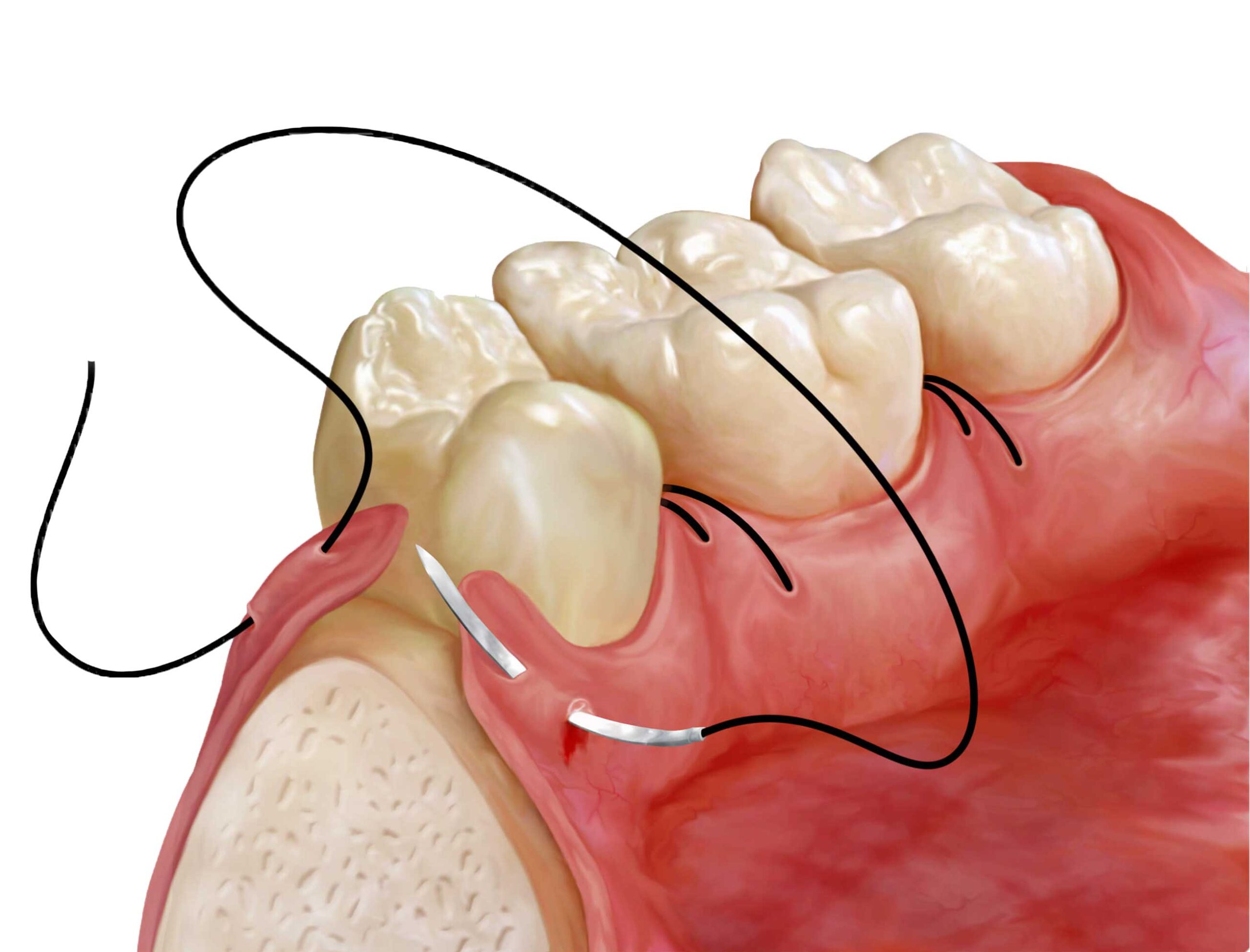 Cirurgia periodontal — retalho — enxerto gengival