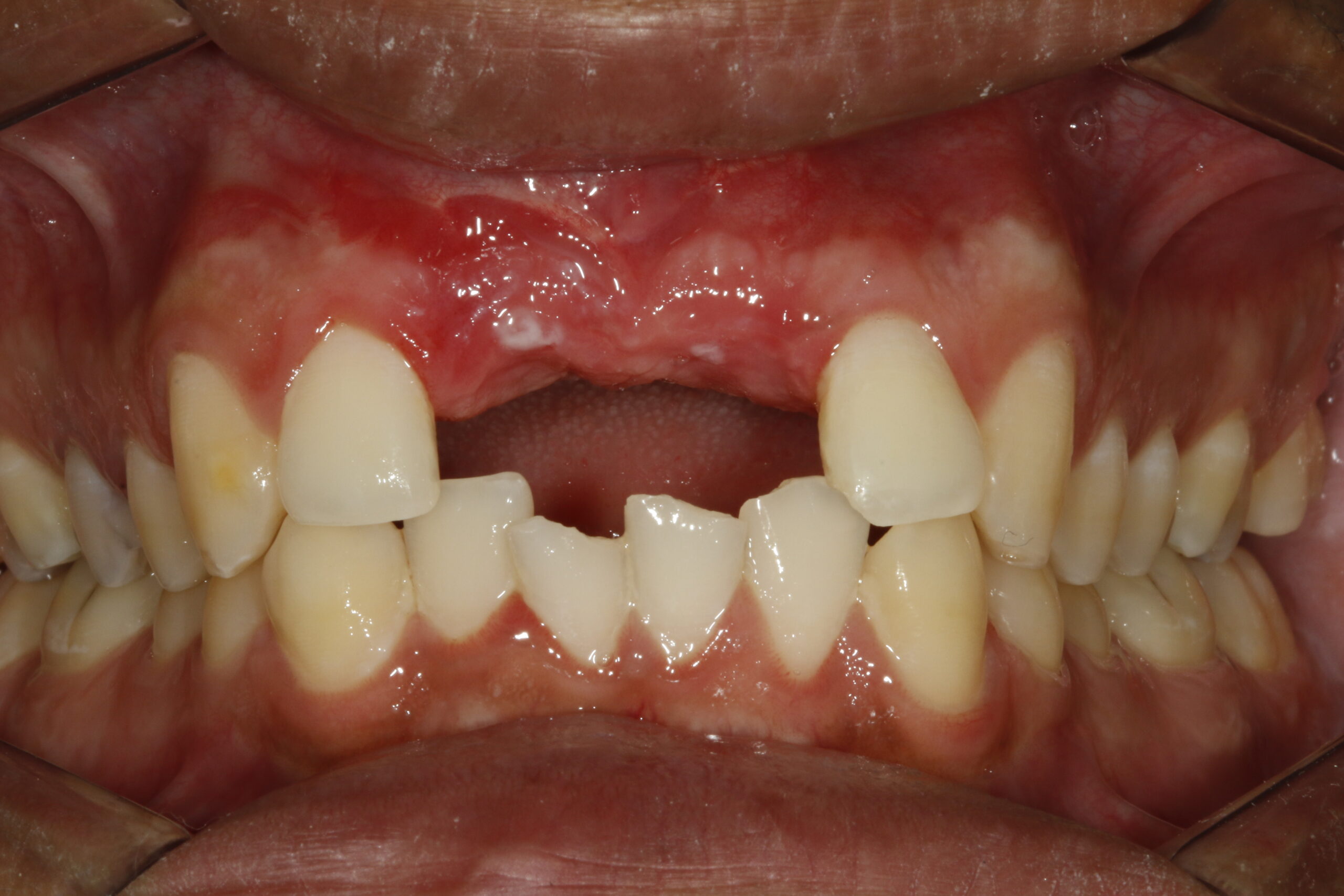 Implante dentário unitário Divinópolis — antes e depois