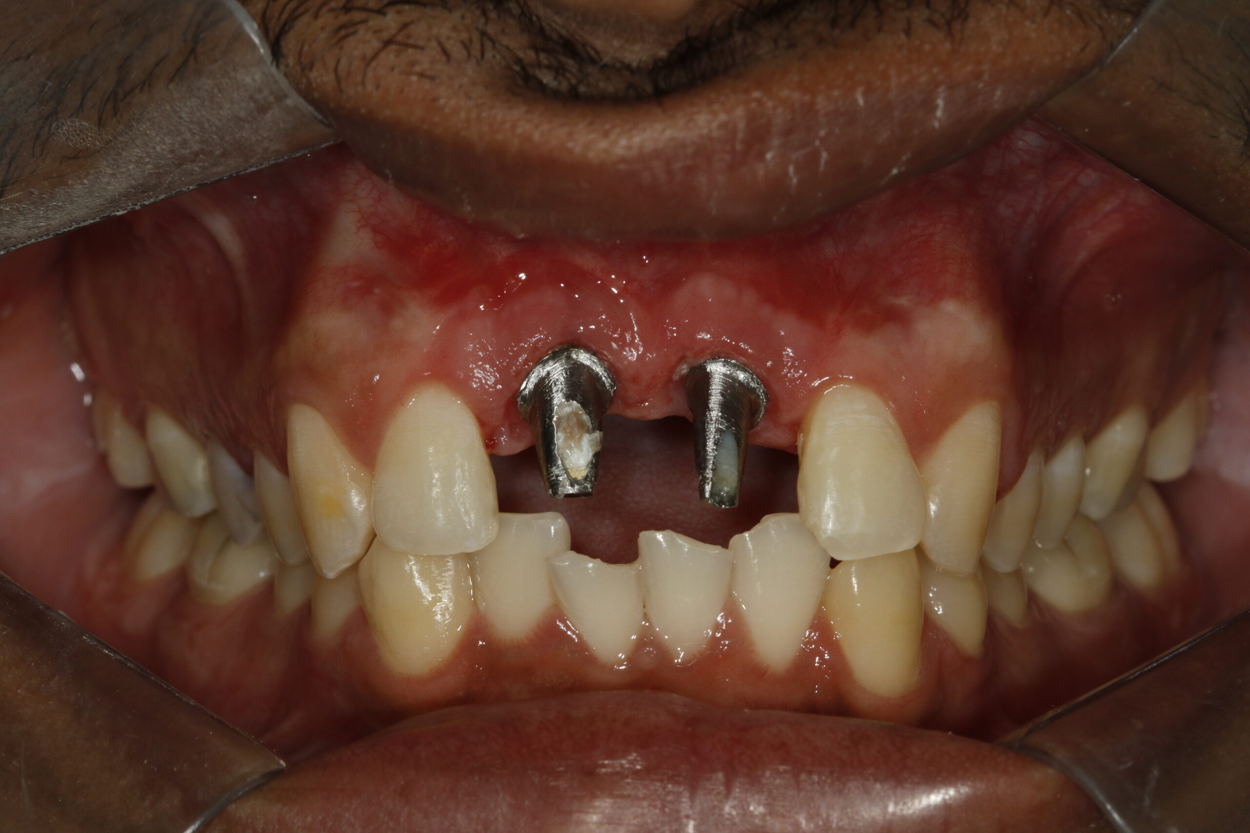 Resultado caso clínico unitário — sorriso restaurado