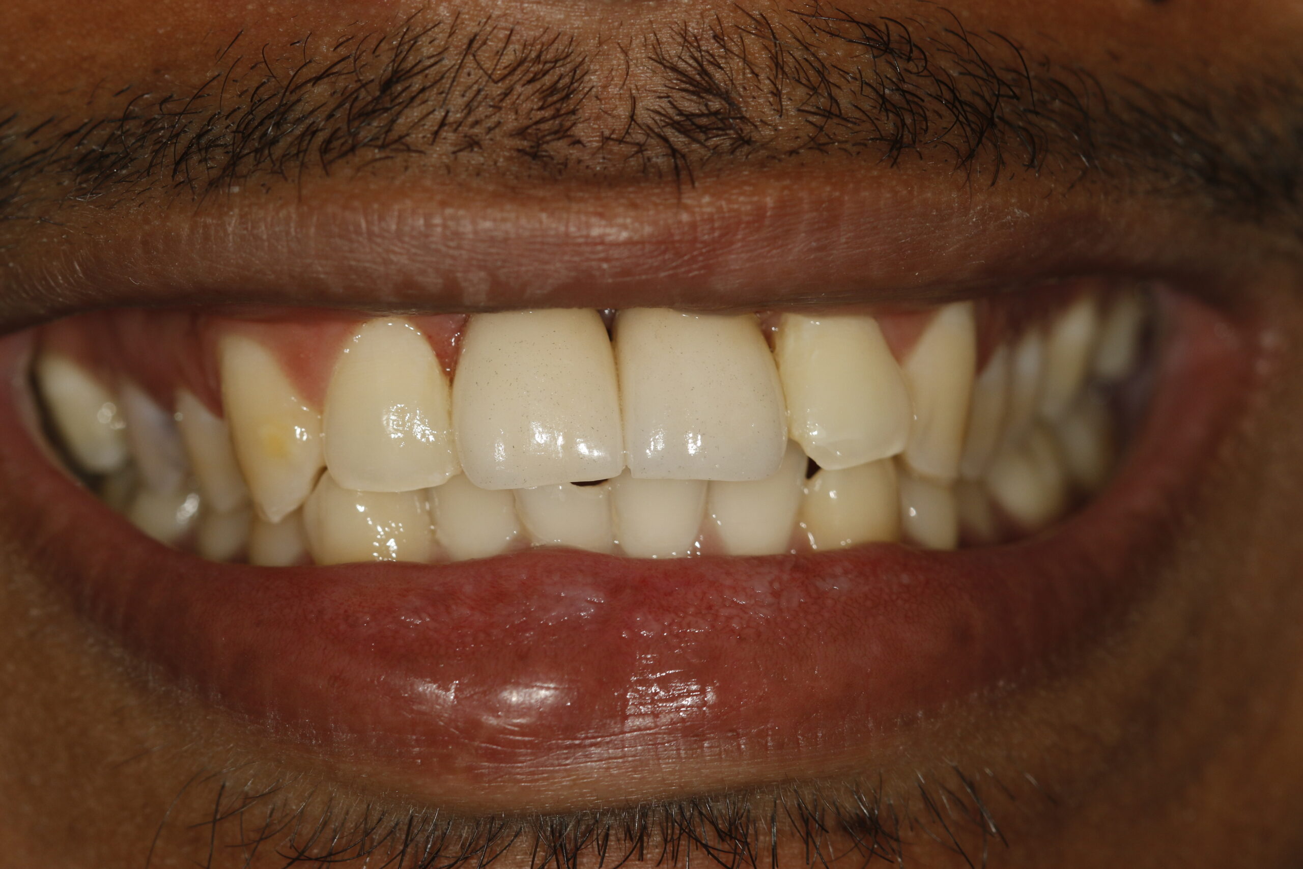 Antes e depois prótese sobre implante — Divinópolis