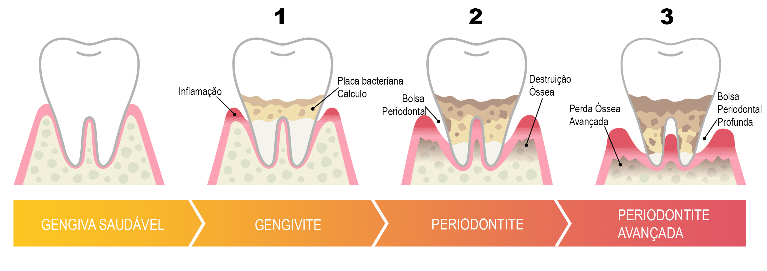 Infográfico evolução da periodontite — gengiva saudável, gengivite, periodontite e periodontite avançada — Dr. Luís Morato Divinópolis MG