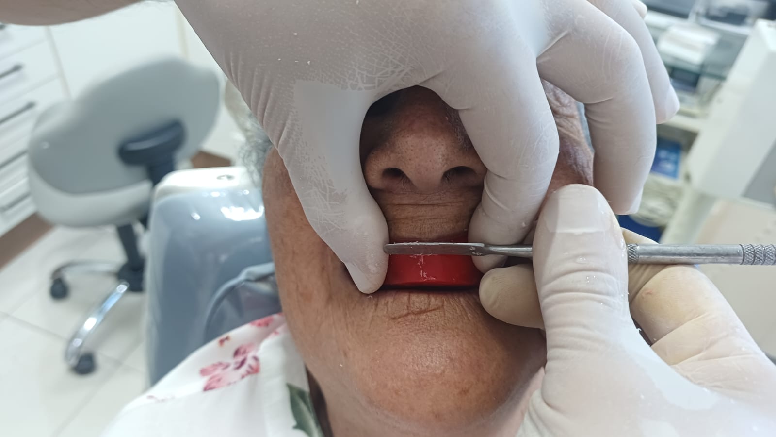 Marcação da linha alta do sorriso — altura dos dentes