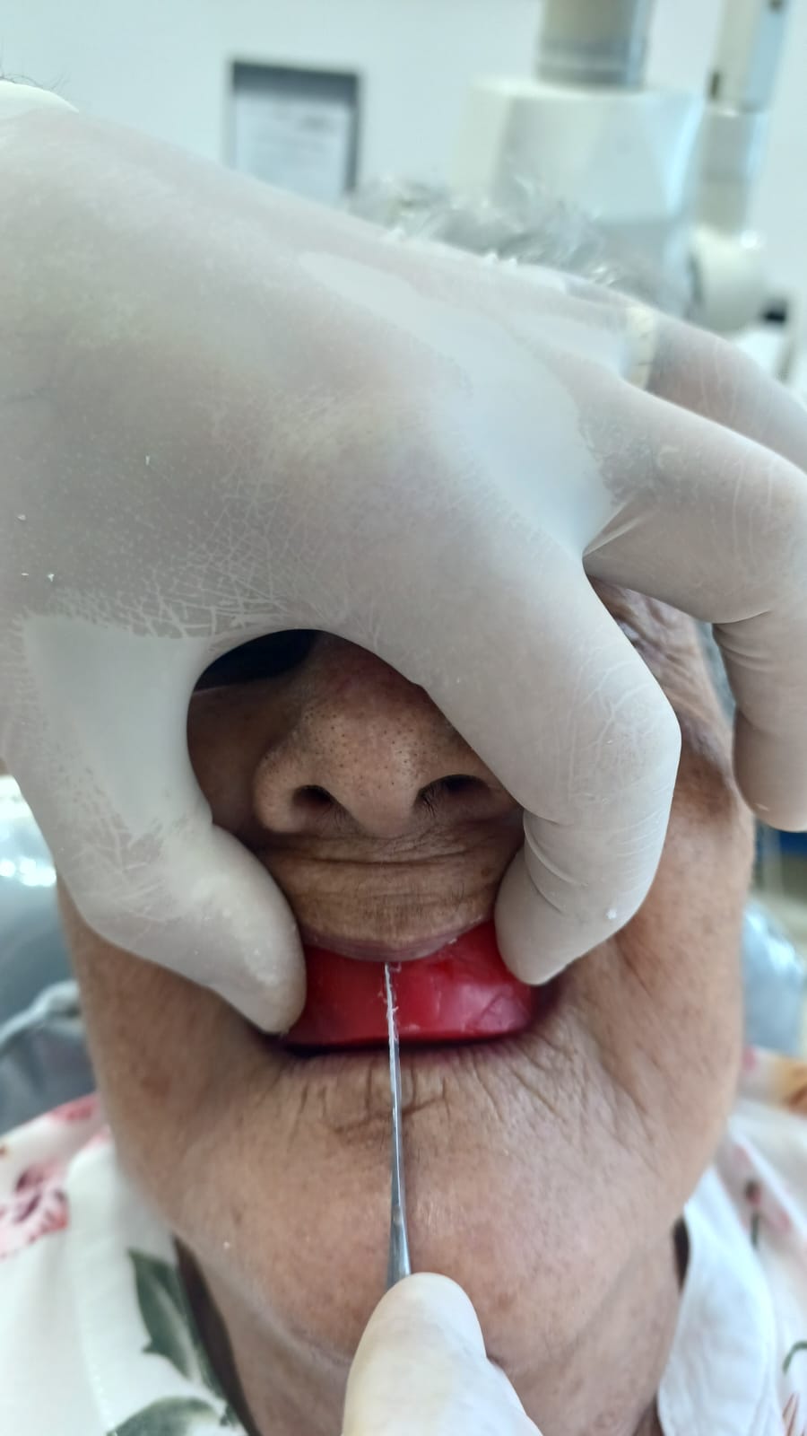 Marcação da linha média no plano de cera