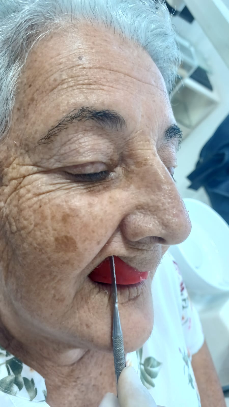 Marcação da posição do canino direito