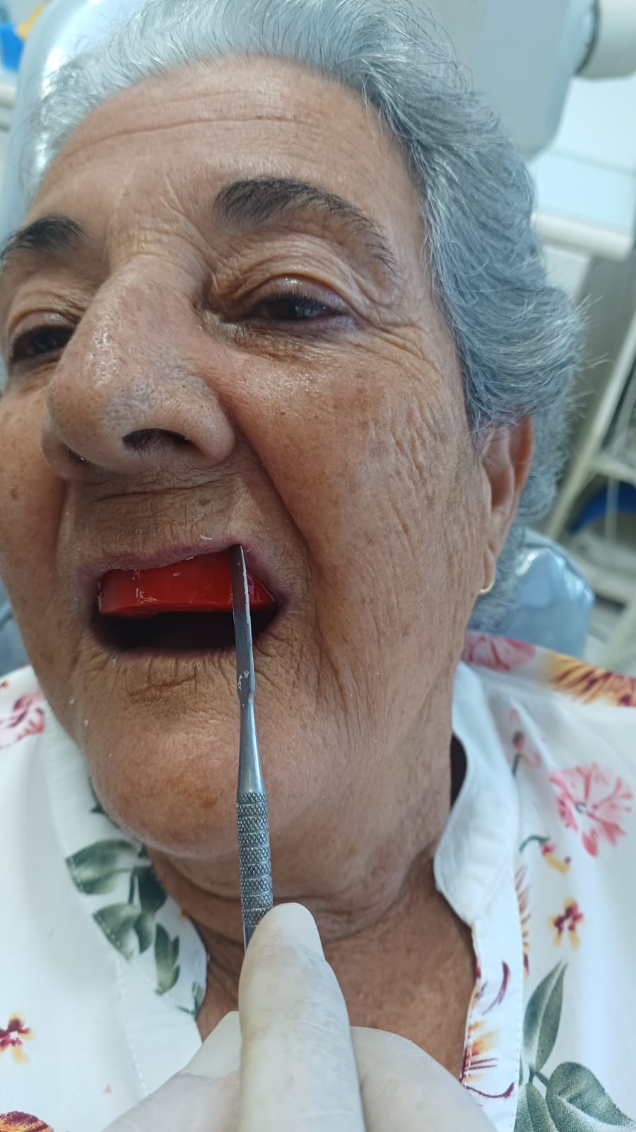 Marcação da posição do canino esquerdo