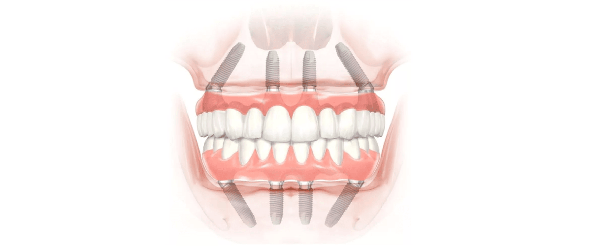 Reabilitação oral Divinópolis — dentadura fixa sobre implantes