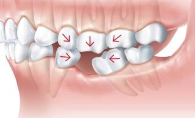 Dente faltando — migração dos dentes vizinhos e supraerupção do dente oposto — trauma de oclusão