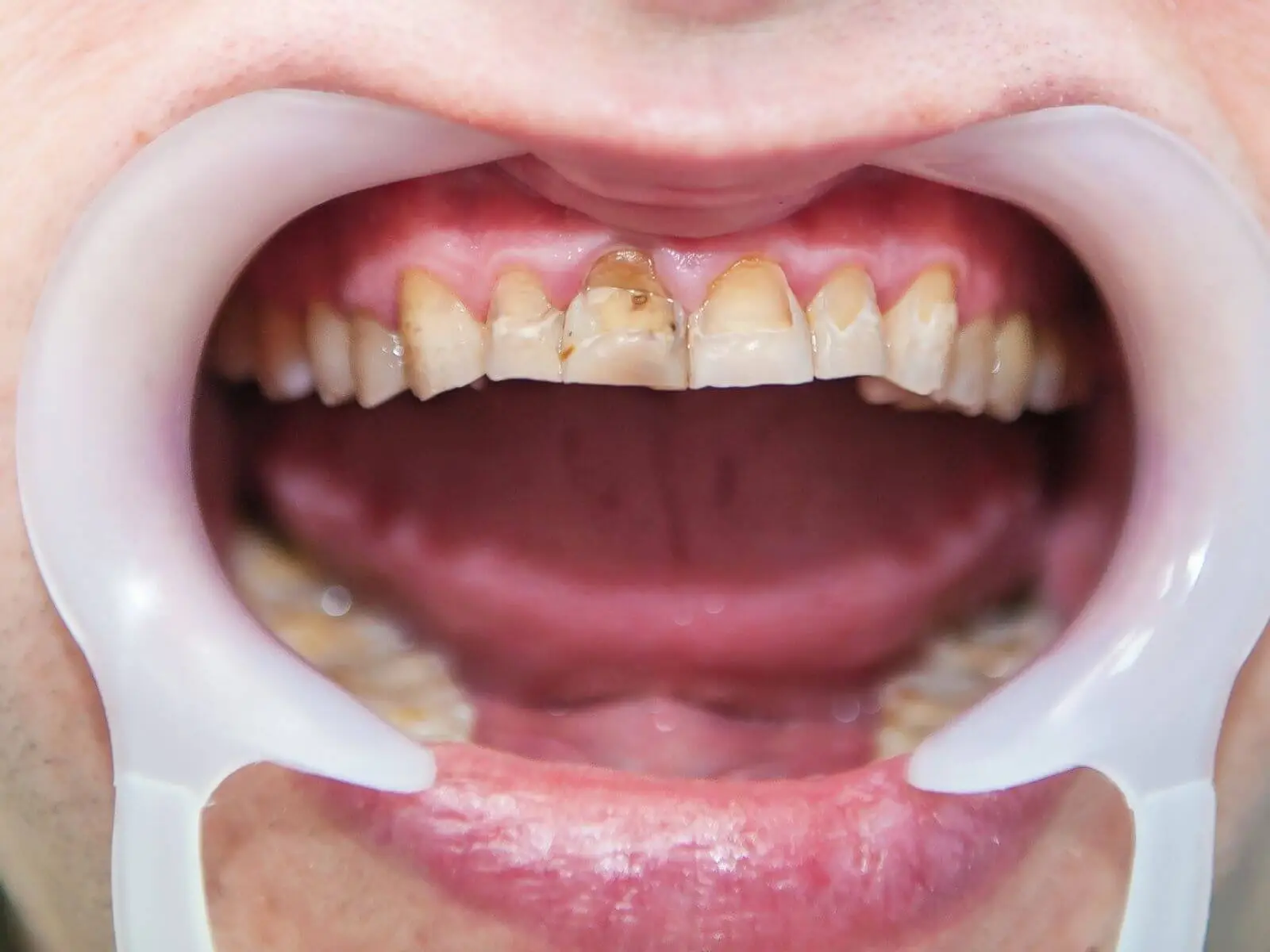 Exemplo de dentes com manchas severas por tetraciclina ou amelogênese imperfeita — caso em que o desgaste para facetas é justificado