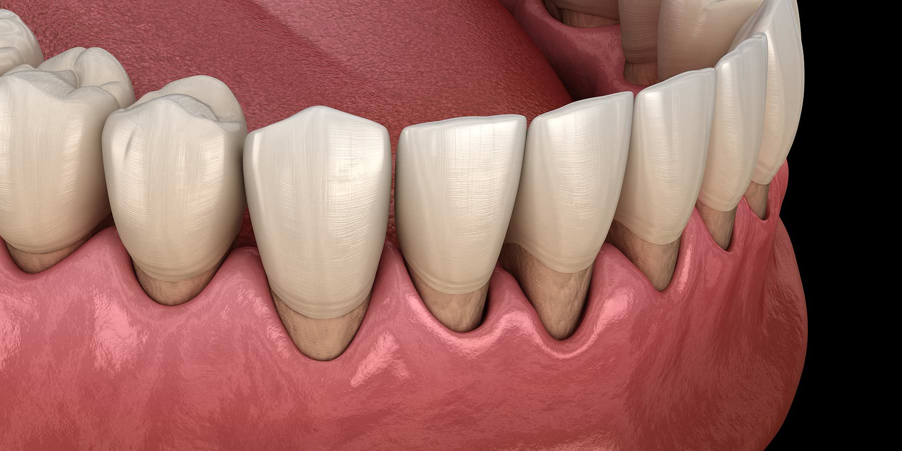 Recessão gengival causada por trauma oclusal — gengiva descendo — enxerto gengival Divinópolis MG
