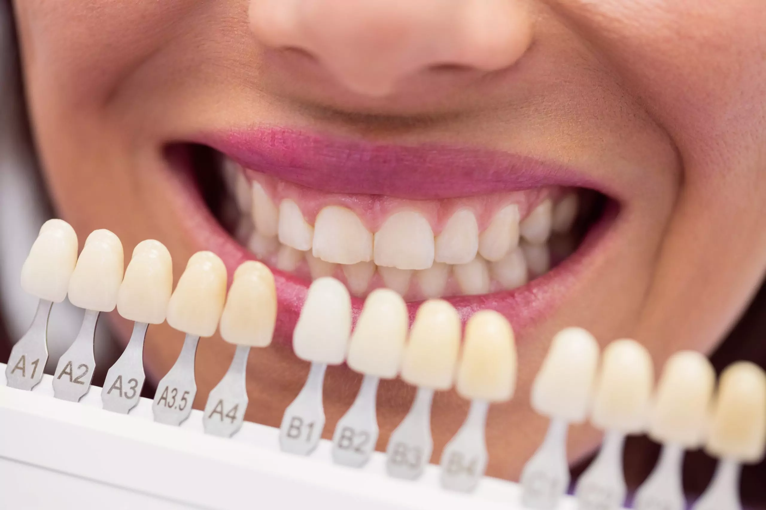 Escala Vita Classical — referência de cores naturais dos dentes, todas em tons de amarelo