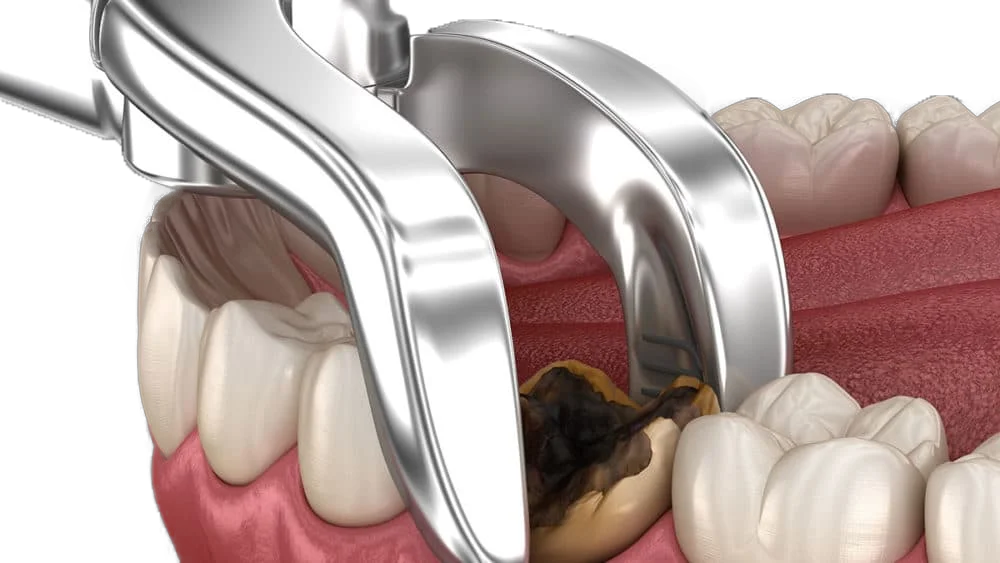 Extração dentária — dente perdido sem substituição inicia o trauma oclusal — periodontista Divinópolis MG