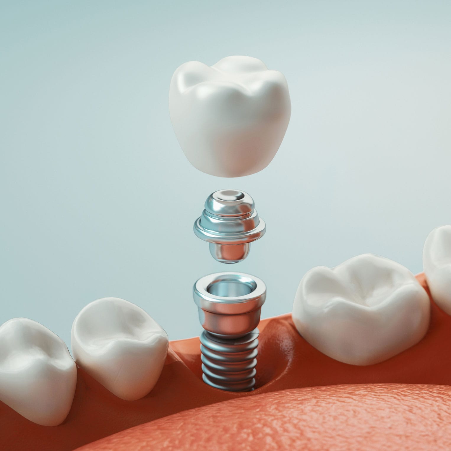 Reabilitação oral Divinópolis — implante dentário para repor dente perdido
